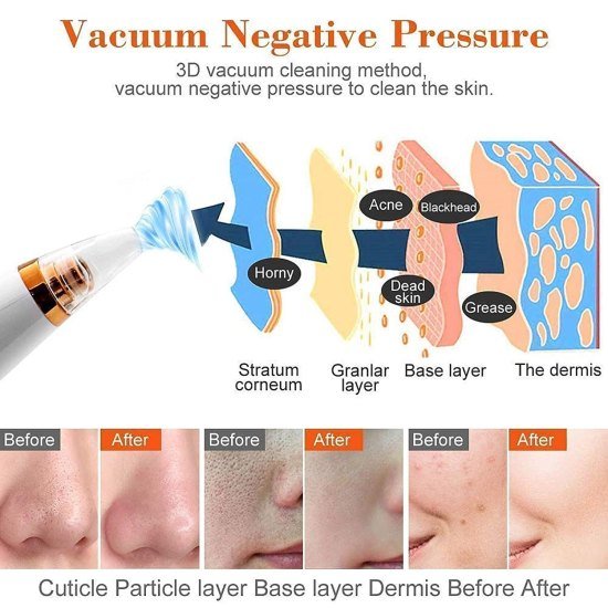 6 In 1 Derma Suction blackhead remover machine Personal Care