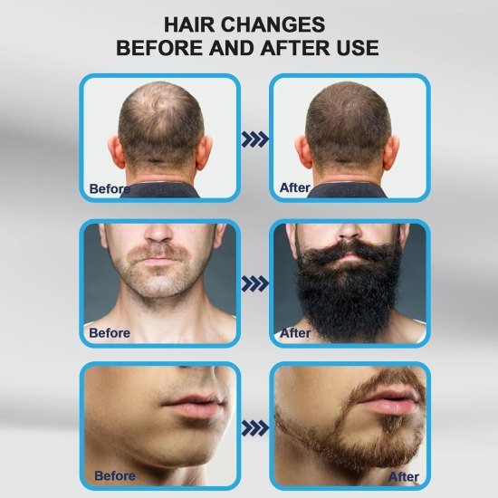 Derma microneedle Stamp Personal Care