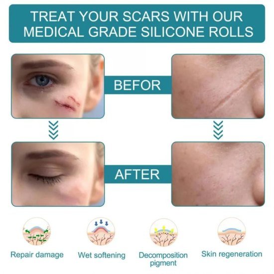 Silicone Scar Removal Sheet Personal Care
